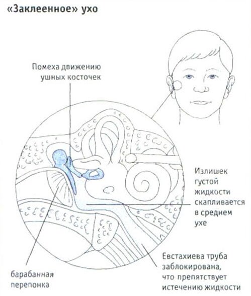 "Заклеенное" ухо "Заклеенное" ухо