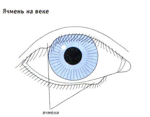 Ячмень на веке Ячмень на веке