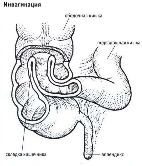 Инвагинация Инвагинация