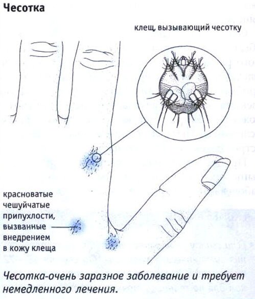 Чесотка Чесотка