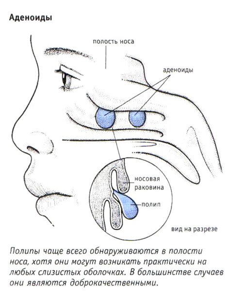 Полипы Полипы