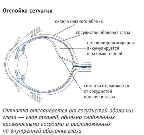 Отслойка сетчатки глаза Отслойка сетчатки глаза