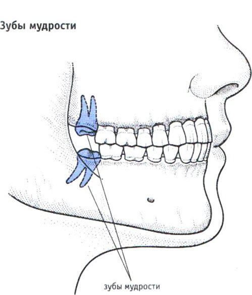 Зубы мудрости Зубы мудрости