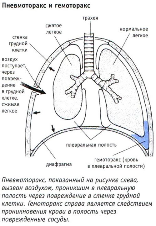 Пневмоторакс и гемоторакс Пневмоторакс и гемоторакс