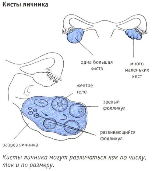 Кисты яичника Кисты яичника