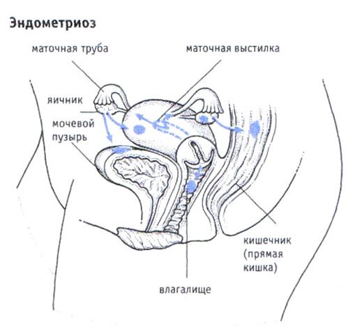 Эндометриоз Эндометриоз