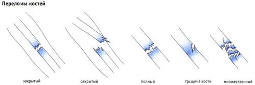 Переломы костей Переломы костей