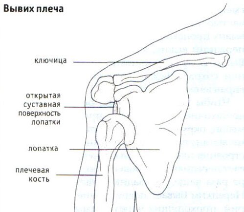 Вывих плеча Вывих плеча