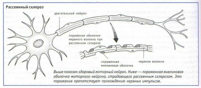 Рассеянный склероз Рассеянный склероз