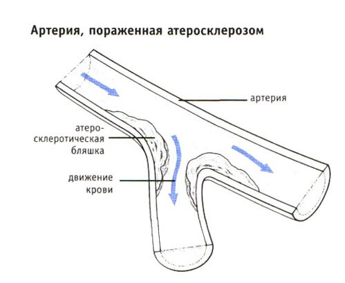 Артерия, пораженная атеросклерозом Артерия, пораженная атеросклерозом