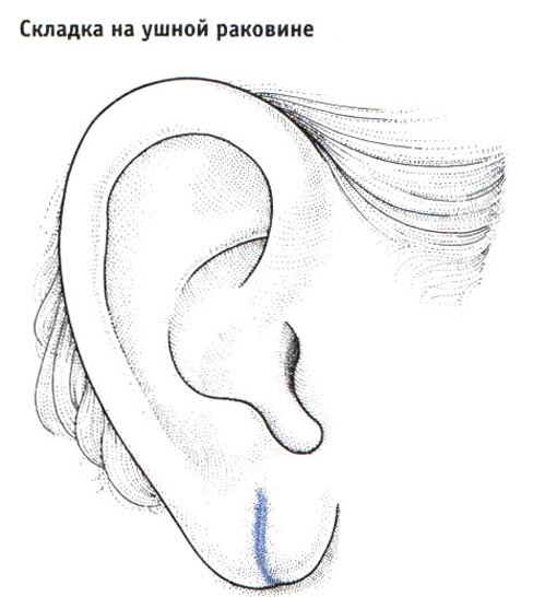 Складка на ушной раковине Складка на ушной раковине