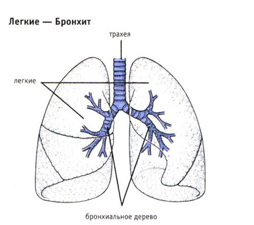 Легкие.Бронхит Легкие.Бронхит