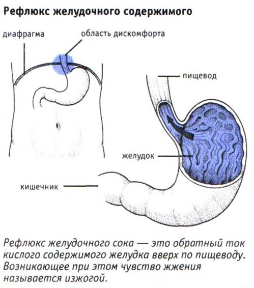 Рефлюкс желудочного содержимого Рефлюкс желудочного содержимого