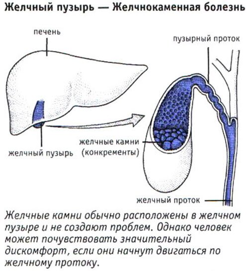 Желчный пузырь.Желчнокаменная болезнь Желчный пузырь.Желчнокаменная болезнь