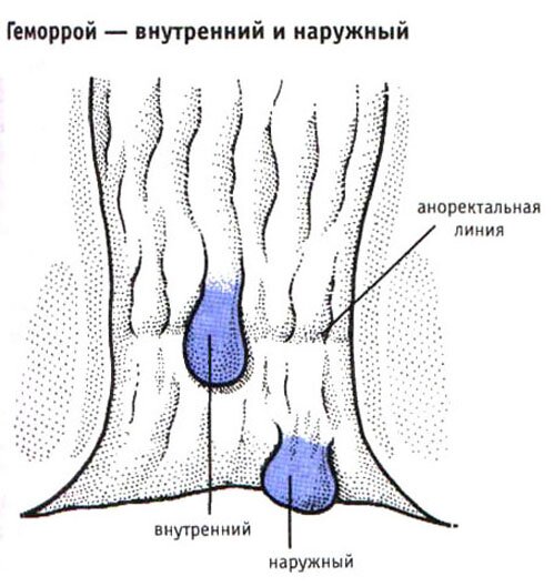 Геморрой-внутренний и наружный Геморрой-внутренний и наружный