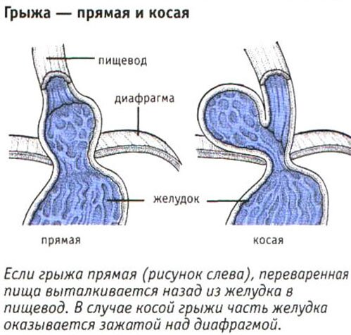 Грыжа-прямая и косая Грыжа-прямая и косая