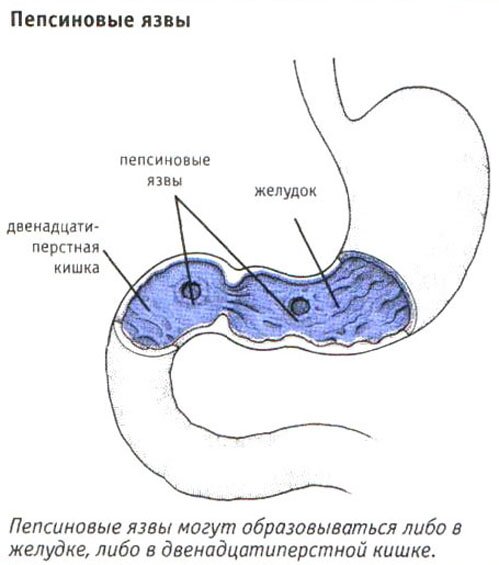 Пептические (пепсиновые) язвы Пептические (пепсиновые) язвы