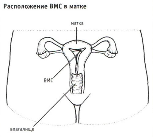 Расположение спирали в матке Расположение спирали в матке
