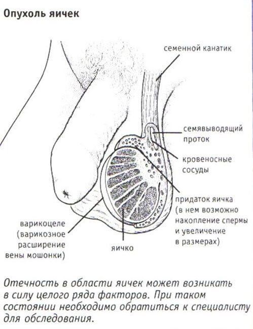 Опухоль яичек Опухоль яичек
