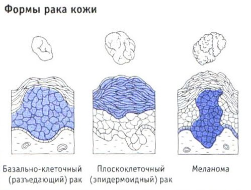 Формы рака кожи Формы рака кожи