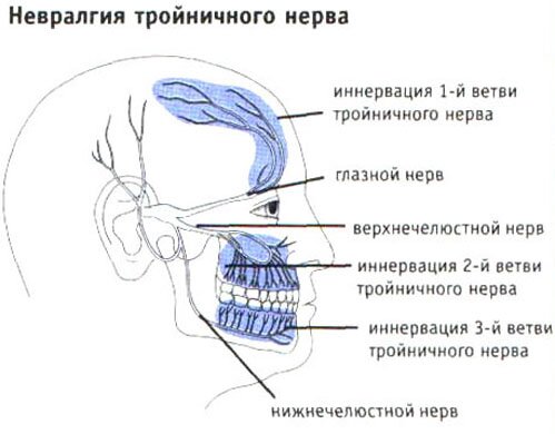 Невралгия тройничного нерва Невралгия тройничного нерва