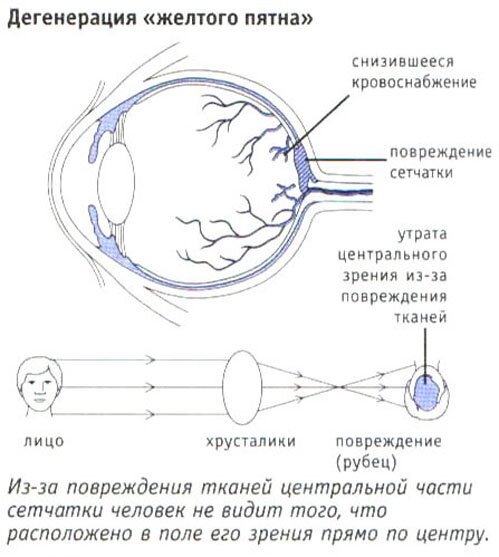 Дегенерация "желтого пятна" Дегенерация "желтого пятна"