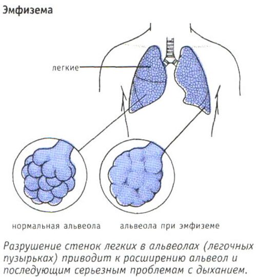 Эмфизема Эмфизема