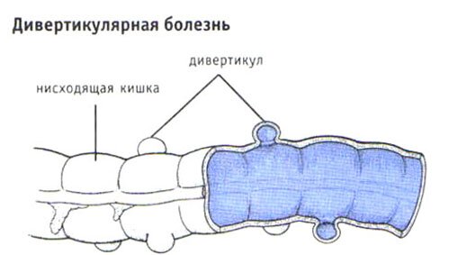 Дивертикулярная болезнь Дивертикулярная болезнь