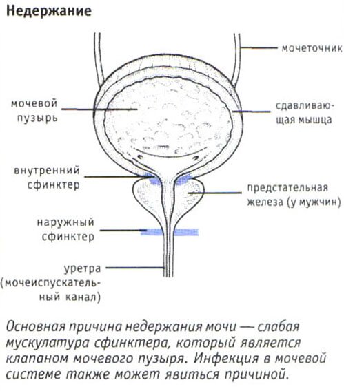 Недержание мочи Недержание мочи