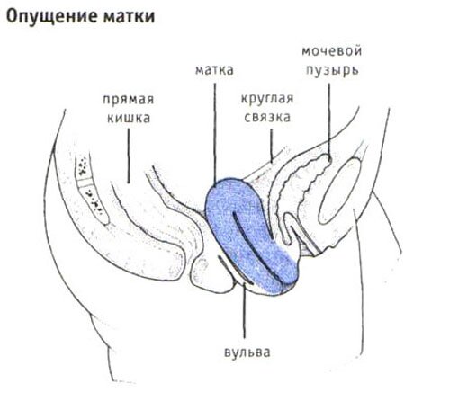 Опущение матки Опущение матки