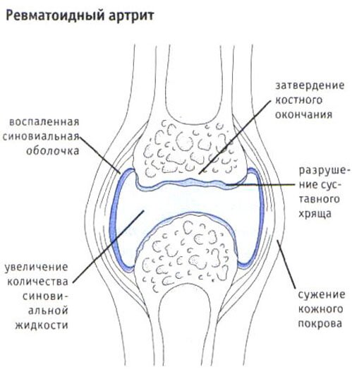 Ревматоидный артрит Ревматоидный артрит