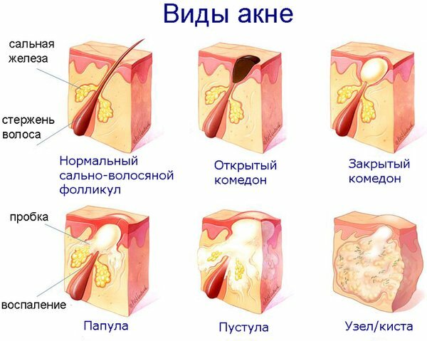 Как избавиться от прыщей? Как избавиться от прыщей?